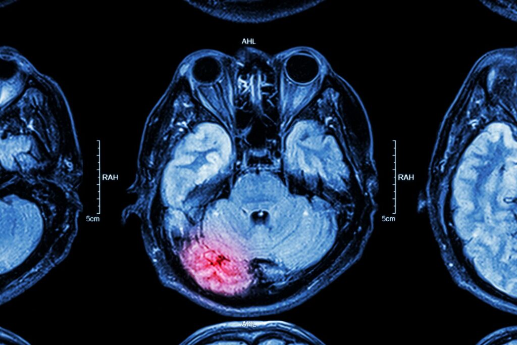 MRI of brain with brain injury